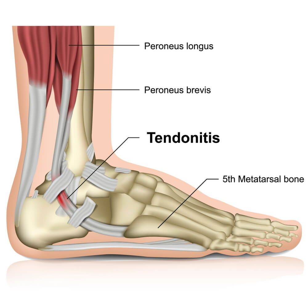 Peroneal Tendonitis Matthew Appleton